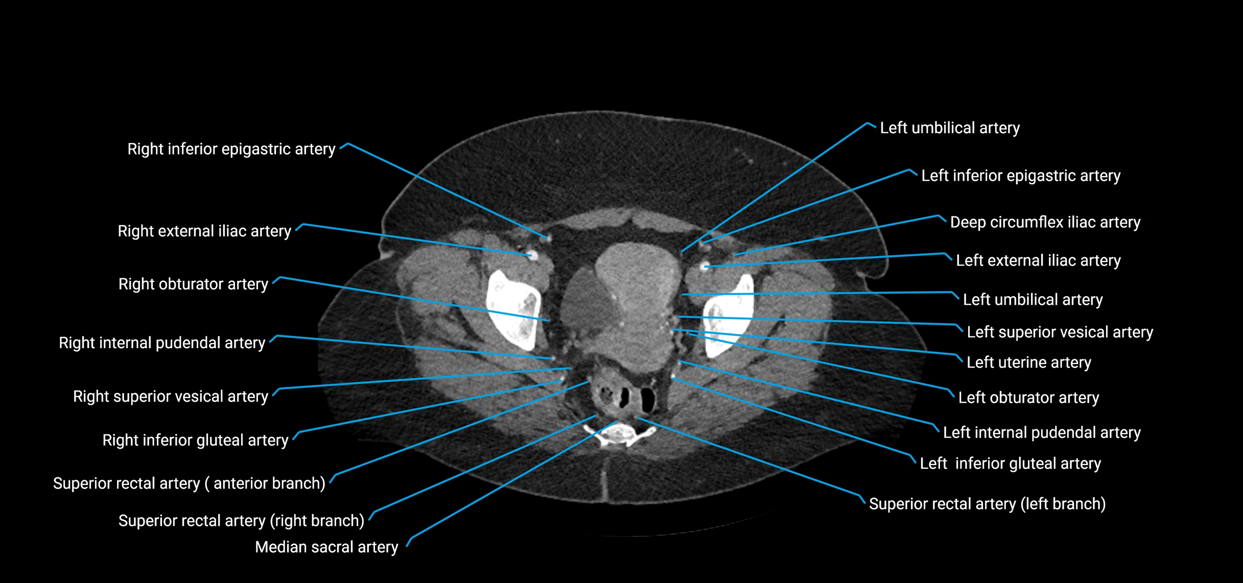 CTA abdomen axial cross sectional anatomy labelled image_229 (2).webp